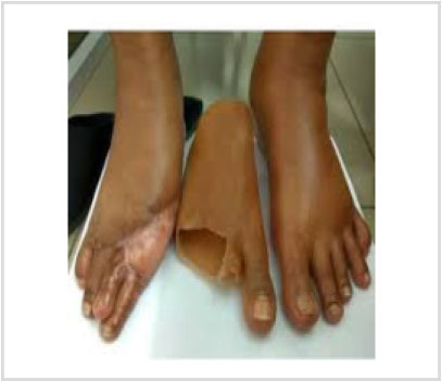 Artificial Limbs & Cosmetic Prosthesi