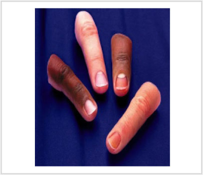 Artificial Limbs & Cosmetic Prosthesi